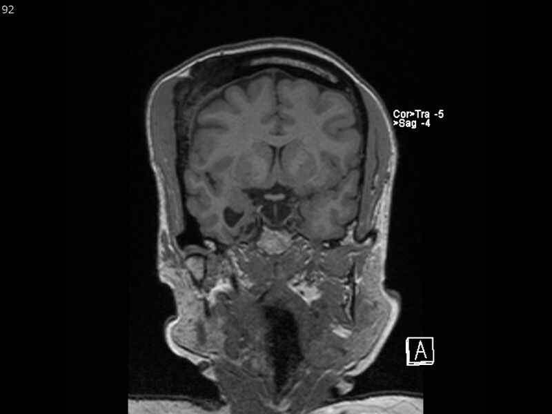 File:Atypical meningioma - intraosseous (Radiopaedia 64915-74572 Coronal T1 92).jpg