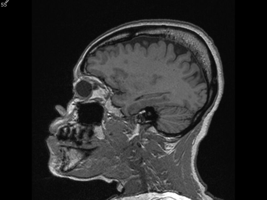 Atypical meningioma - intraosseous (Radiopaedia 64915-74572 Sagittal T1 55).jpg