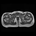 Avascular necrosis of the hip (Radiopaedia 29563-30067 Axial T1 13).jpg