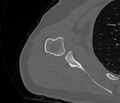 Avulsion fracture - greater tuberosity of humerus (Radiopaedia 71216-81514 Axial bone window 51).jpg