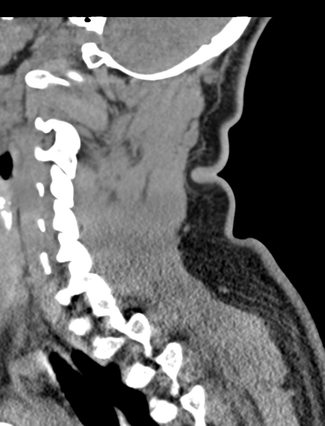 File:Axis peg fracture (type 3) and atlas lateral mass (type 4) fracture (Radiopaedia 37474-39324 D 52).png