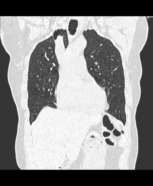 File:Azygos fissure and azygos lobe (Radiopaedia 41841-44832 Coronal lung window 3).jpg