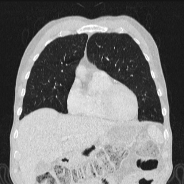 File:Azygos lobe (Radiopaedia 38259-40275 Coronal lung window 23).jpg