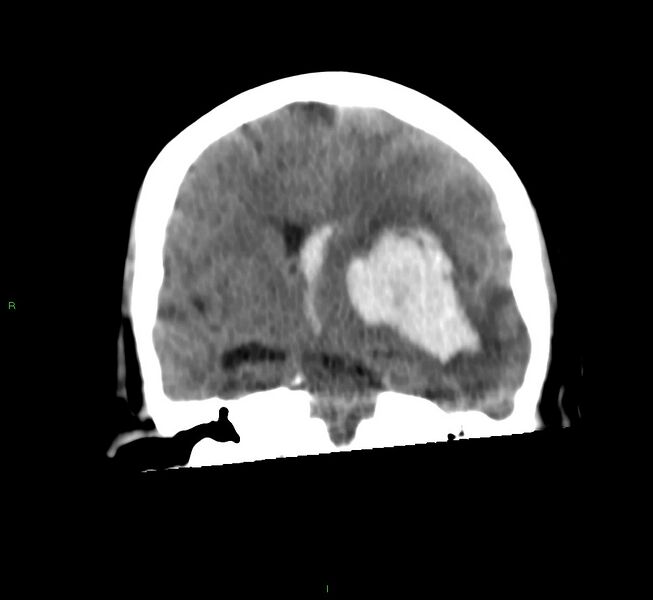 File:Basal ganglia hemorrhage (Radiopaedia 58759-65981 Coronal non-contrast 40).jpg