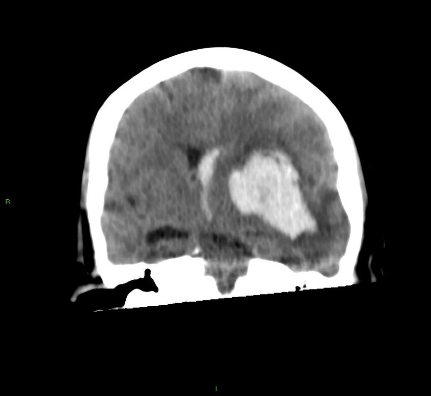Basal ganglia hemorrhage (Radiopaedia 58759-65981 Coronal non-contrast 40).jpg