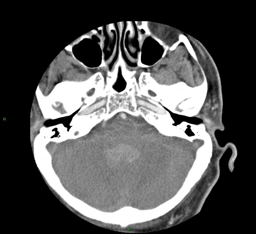 Basal ganglia hemorrhage (Radiopaedia 58763-65985 D 43).jpg