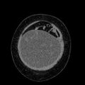 Benign leiomyoma with hydropic features (Radiopaedia 89250-106130 B 20).jpg