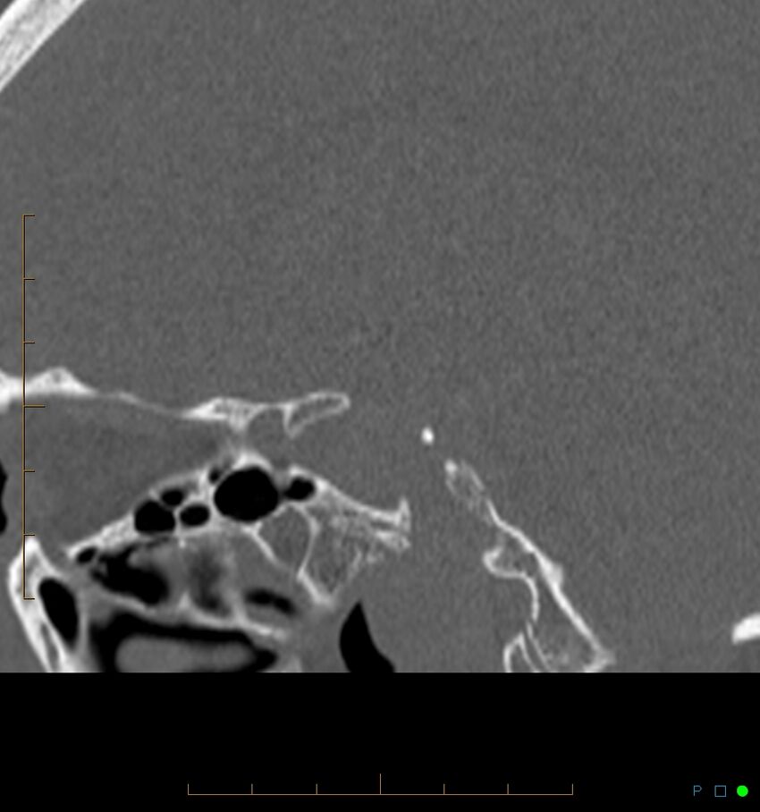 Benign notochordal cell tumor (probable) (Radiopaedia 65475-74546 Sagittal bone window 6).jpg