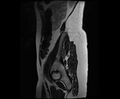 Bicornuate bicollis uterus (Radiopaedia 61626-69616 Sagittal T2 38).jpg