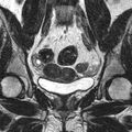 Bicornuate uterus (Radiopaedia 11104-11492 Coronal T2 10).jpg