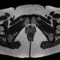 Bicornuate uterus (Radiopaedia 72135-82643 Axial T2 21).jpg