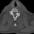 Bilateral C6-7 locked facet dislocation (Radiopaedia 28506-28748 Axial bone window 23).jpeg
