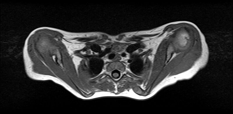 File:Bilateral Sprengel deformity with Klippel-Feil syndrome (Radiopaedia 66395-75650 Axial T1 21).jpg