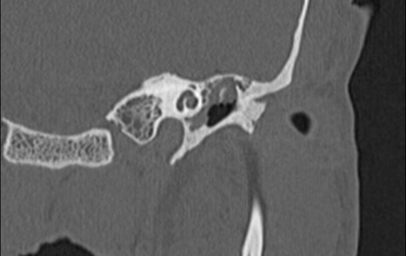 File:Bilateral cholesteatoma (Radiopaedia 54898-61172 D 7).jpg