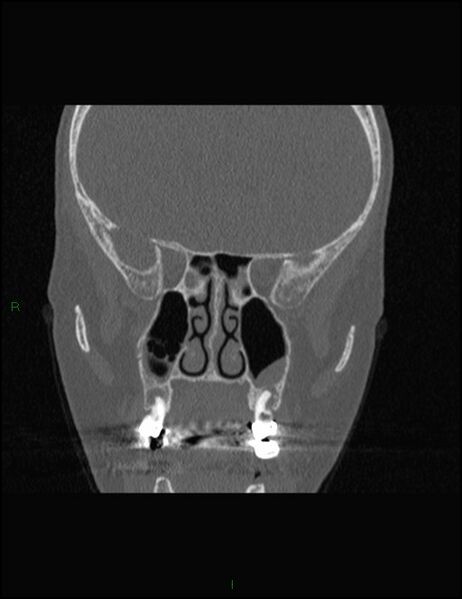 File:Bilateral frontal mucoceles (Radiopaedia 82352-96454 Coronal 175).jpg