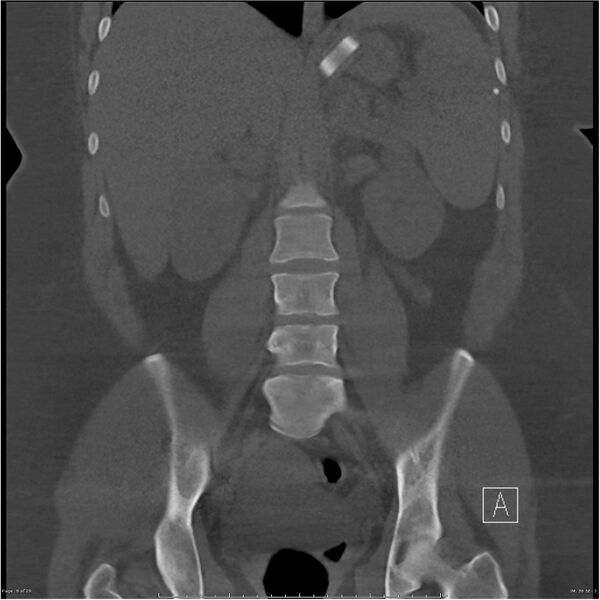 File:Bilateral lumbar ribs (Radiopaedia 25862-26010 Coronal bone window 8).jpg