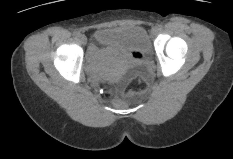 File:Bilateral mature cystic ovarian teratoma (Radiopaedia 88821-105592 Axial non-contrast 35).jpg