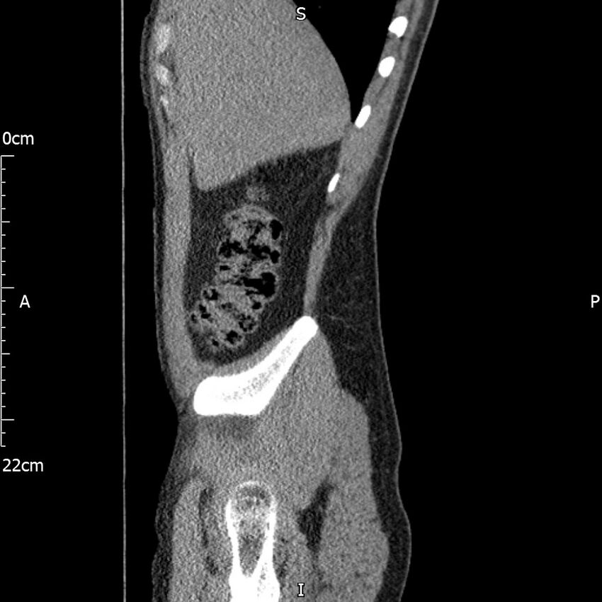 Bilateral medullary nephrocalcinosis with ureteric calculi (Radiopaedia 71269-81569 C 93).jpg