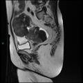 Bilateral ovarian fibroma (Radiopaedia 44568-48293 Sagittal T2 13).jpg