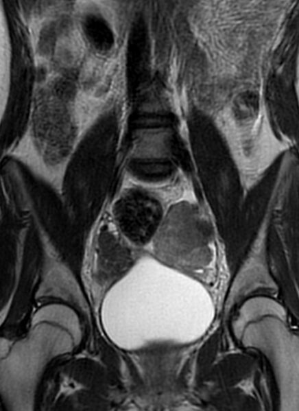File:Bilateral ovarian fibrothecomas - adolescent (Radiopaedia 86604-102707 Coronal T2 17).jpg