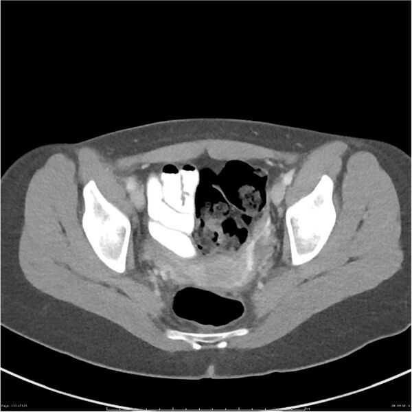 File:Bilateral ureteritis and cystitis (Radiopaedia 25340-25594 A 68).jpg