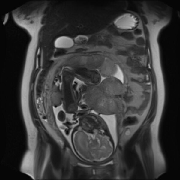 File:Bilobed placenta accreta (Radiopaedia 69648-79591 Coronal T2 18).jpg