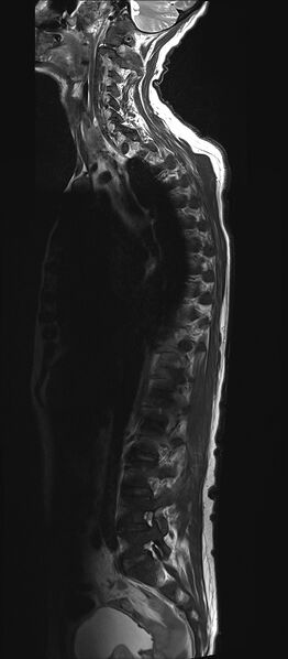File:Bing-Neel syndrome (Radiopaedia 71453-81799 Sagittal T2 1).jpg