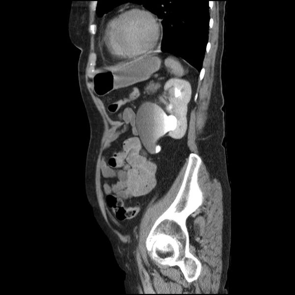 File:Bladder tumor detected on trauma CT (Radiopaedia 51809-57609 E 20).jpg