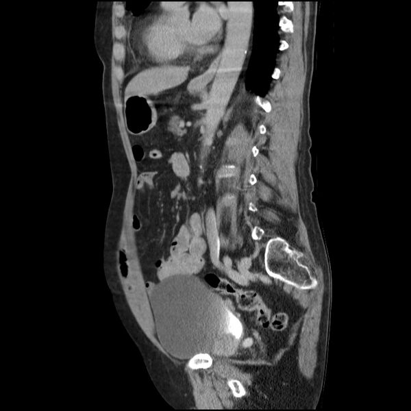 File:Bladder tumor detected on trauma CT (Radiopaedia 51809-57609 E 30).jpg