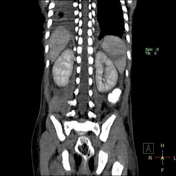 File:Blunt abdominal trauma (Radiopaedia 24780-25044 C 17).jpg