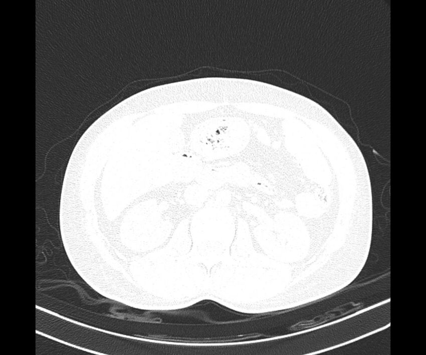 Bochdalek hernia - adult presentation (Radiopaedia 74897-85925 Axial lung window 53).jpg