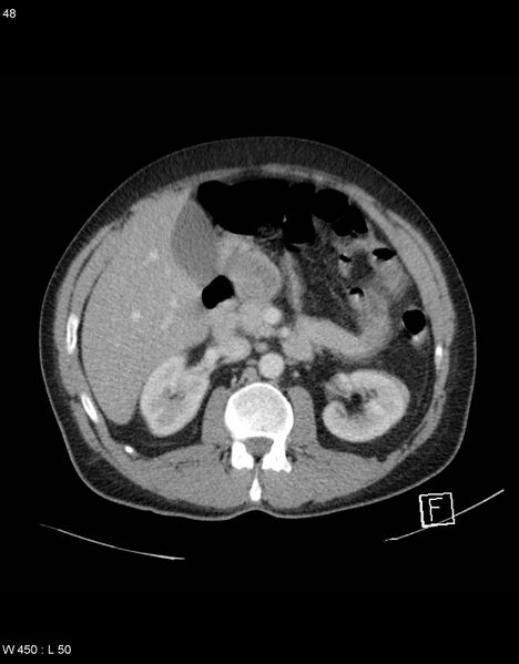 File:Boerhaave syndrome with tension pneumothorax (Radiopaedia 56794-63603 A 24).jpg