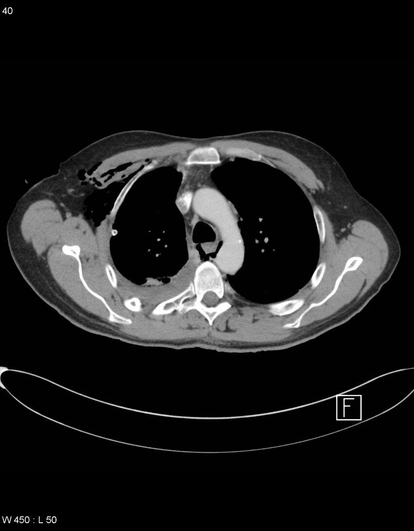 Boerhaave syndrome with tension pneumothorax (Radiopaedia 56794-63605 A 19).jpg