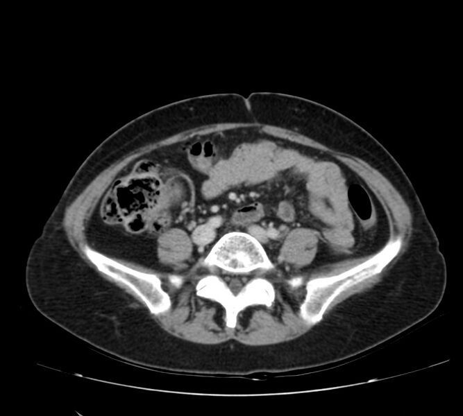 File:Bosniak renal cyst - type IV (Radiopaedia 22929-22953 C 43).jpg