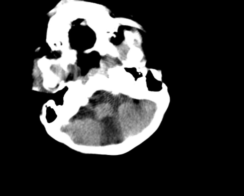 Brachycephaly (bi-coronal and bi-lambdoid synostosis) (Radiopaedia 55048-61413 Axial non-contrast 9).jpg