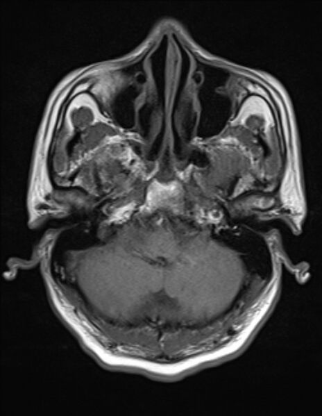 File:Brain abscess with ventriculitis (Radiopaedia 85703-101495 Axial T1 4).jpg