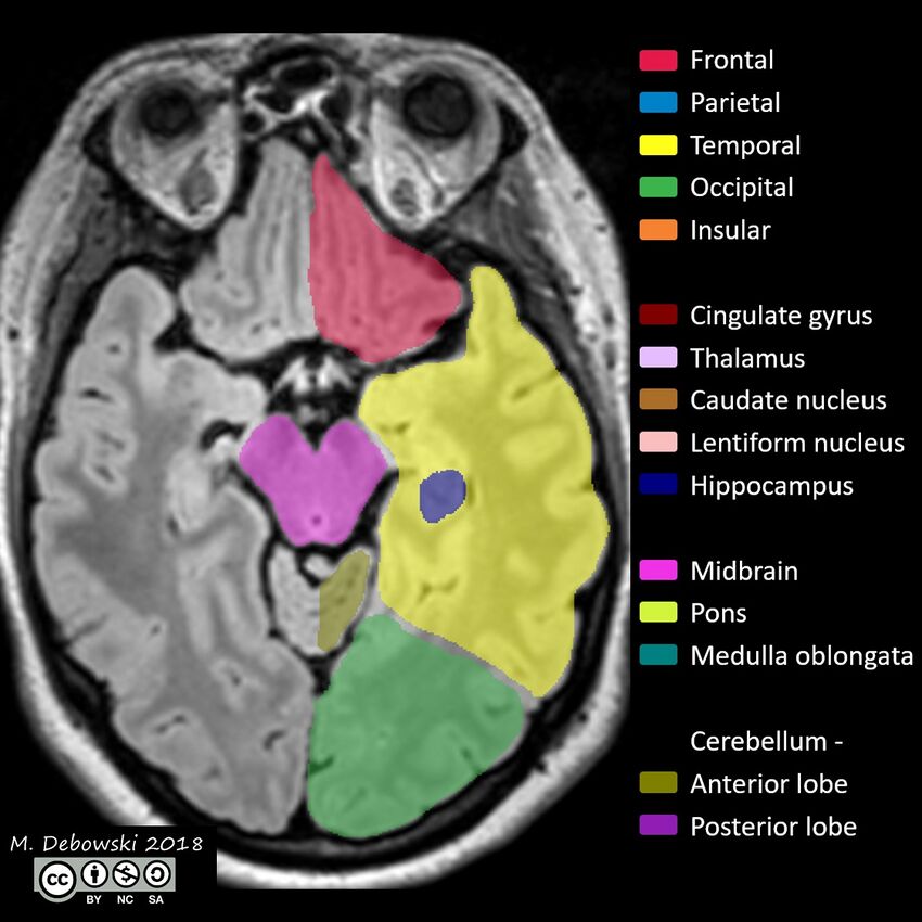 Brain lobes - annotated MRI (Radiopaedia 61691-69700 Axial 47).JPG