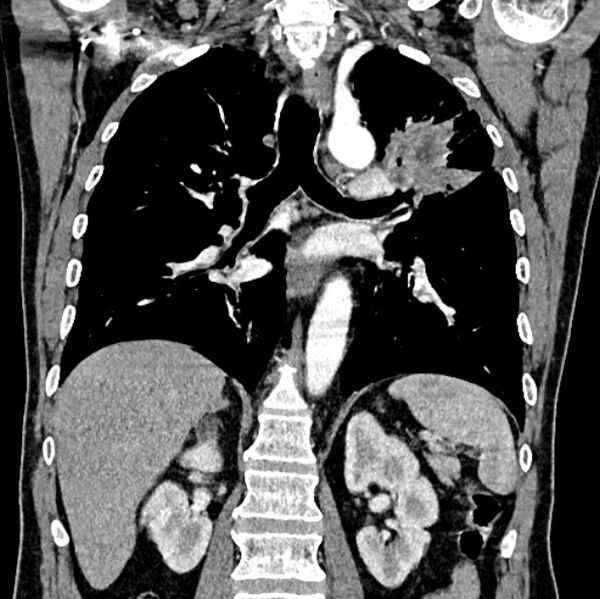 File:Brain metastases - lung cancer primary (Radiopaedia 75060-86116 C+ arterial phase 40).jpg