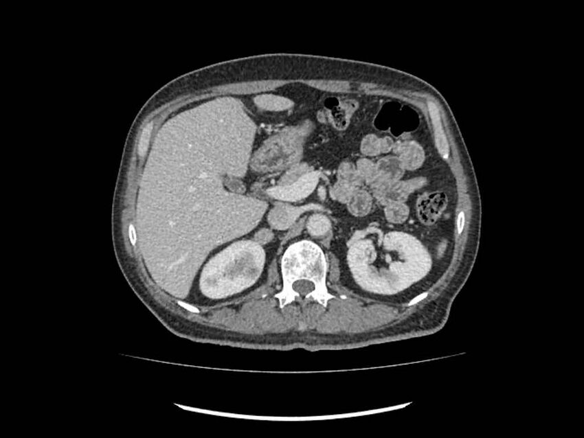 Brain metastases from renal cell carcinoma (Radiopaedia 42222-45328 B 58).jpg
