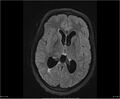 Brainstem glioma (Radiopaedia 21819-21775 Axial FLAIR 21).jpg
