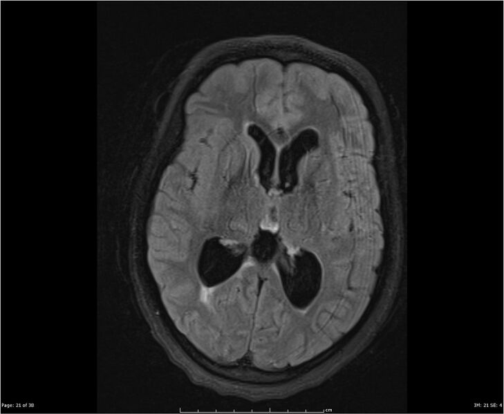 File:Brainstem glioma (Radiopaedia 21819-21775 Axial FLAIR 21).jpg