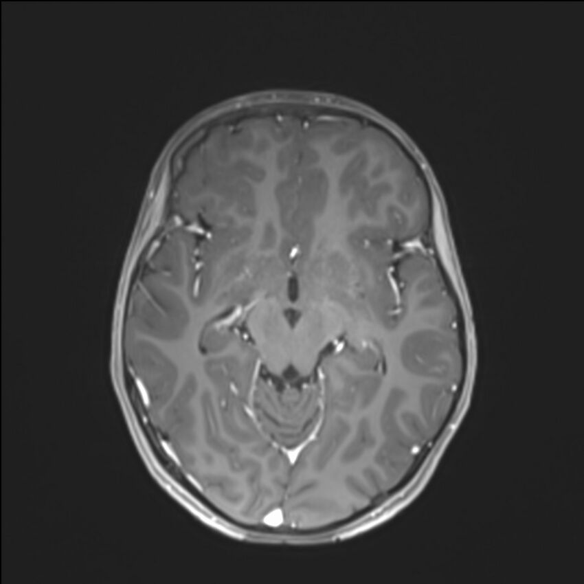 Brainstem glioma (Radiopaedia 70548-80674 Axial T1 C+ 72).jpg