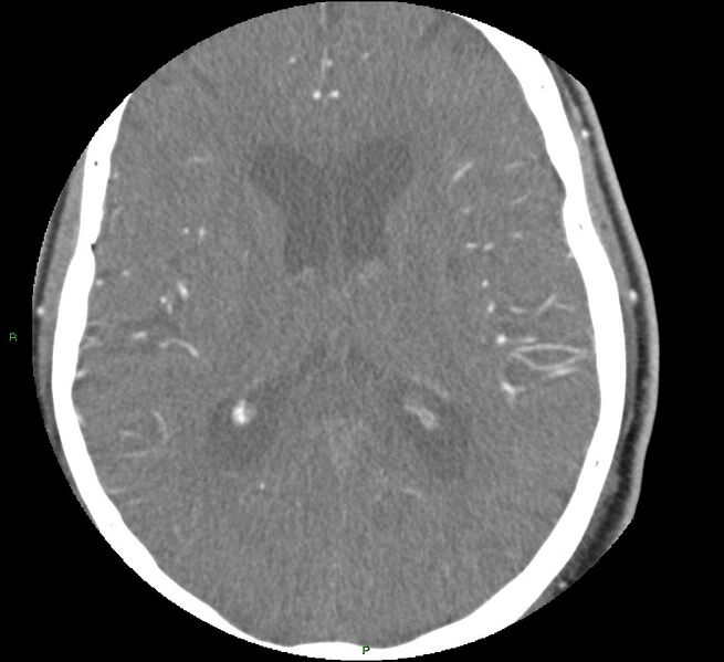 File:Brainstem hemorrhage (Radiopaedia 58794-66028 D 108).jpg