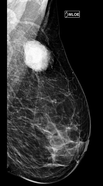 File:Breast fibroadenoma (Radiopaedia 82986-97340 B 1).jpg