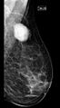 Breast fibroadenoma (Radiopaedia 82986-97340 B 1).jpg