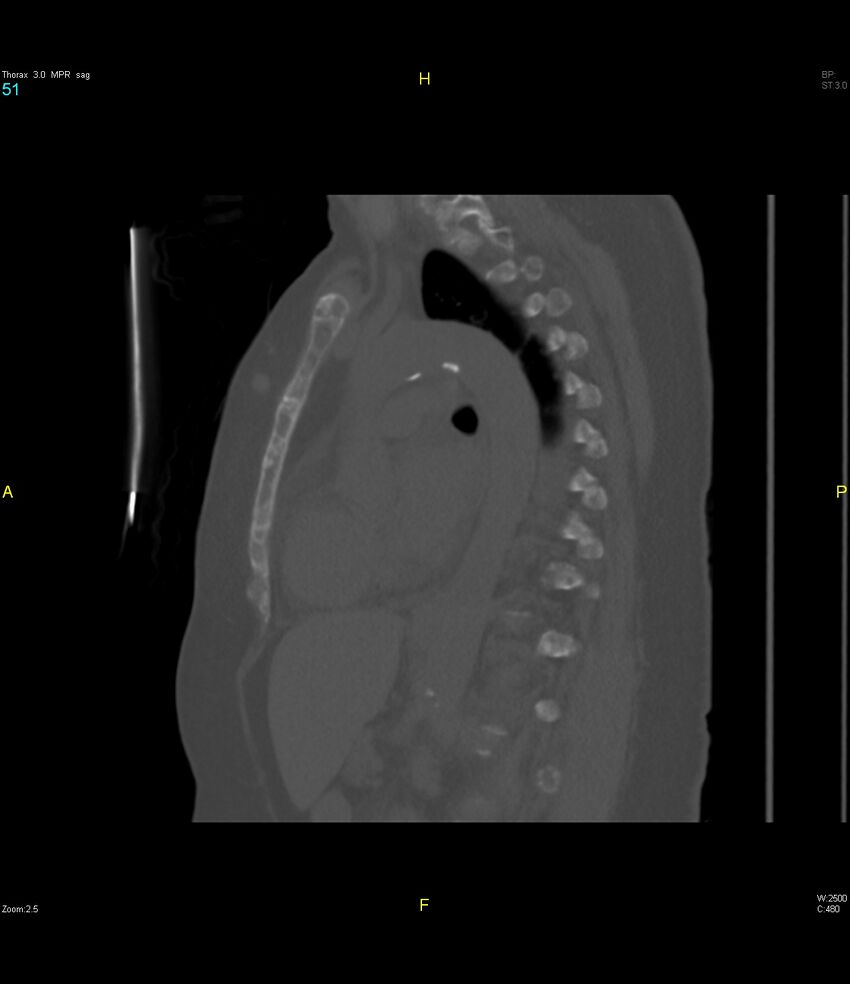 Breast primary with lung and bone metastases (Radiopaedia 40620-43228 Sagittal bone window 51).jpg