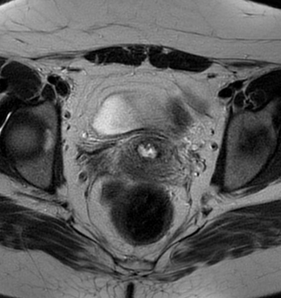 File:Broad ligament leiomyoma (Radiopaedia 81634-95516 Axial T2 16).jpg
