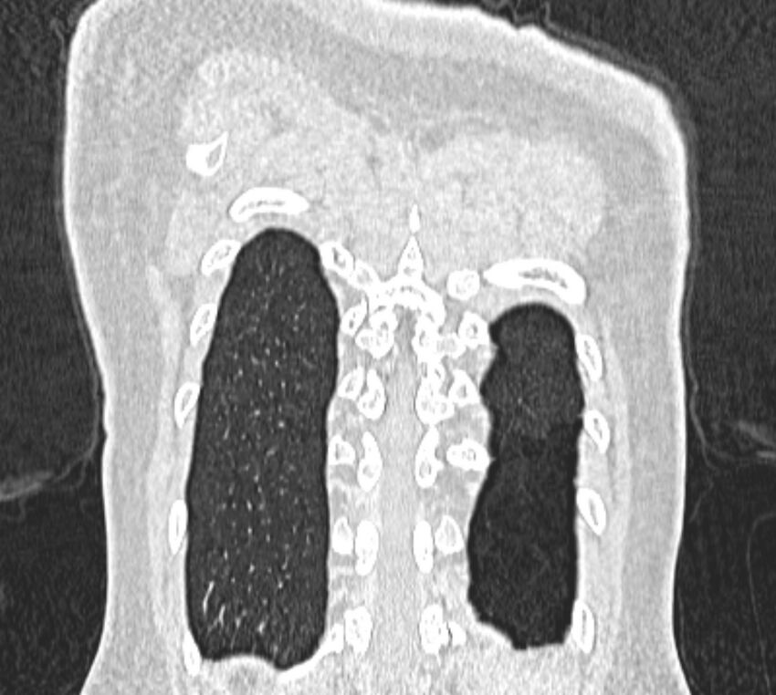Bronchial atresia (Radiopaedia 50007-55297 Coronal lung window 108).jpg