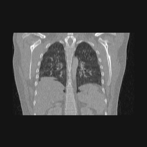 File:Bronchial atresia (Radiopaedia 60685-68439 Coronal lung window 23).jpg
