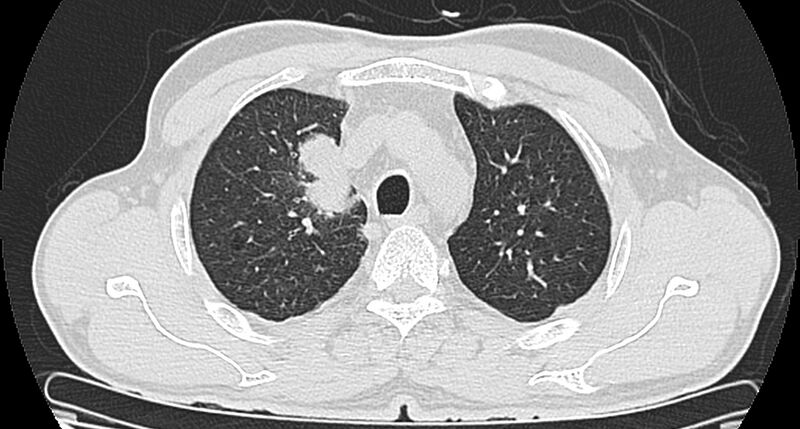 File:Bronchogenic carcinoma with superior vena cava syndrome (Radiopaedia 36497-38054 Axial lung window 27).jpg